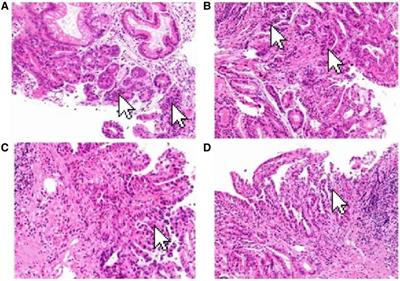 Primary gastric choriocarcinoma: A case report